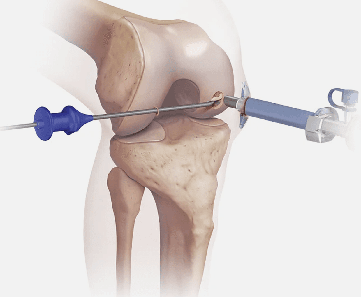 Cartilage Restoration Procedures