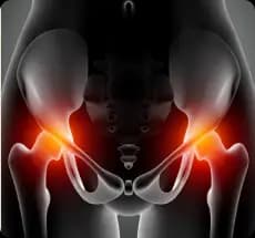 Hip Replacement