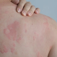 Allergic Reactions