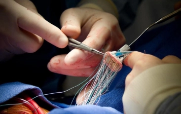 Heart Valve Surgery
