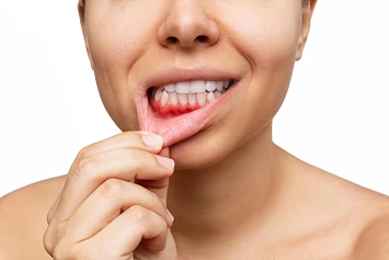 Bleeding Gums