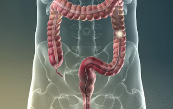 Colonoscopy