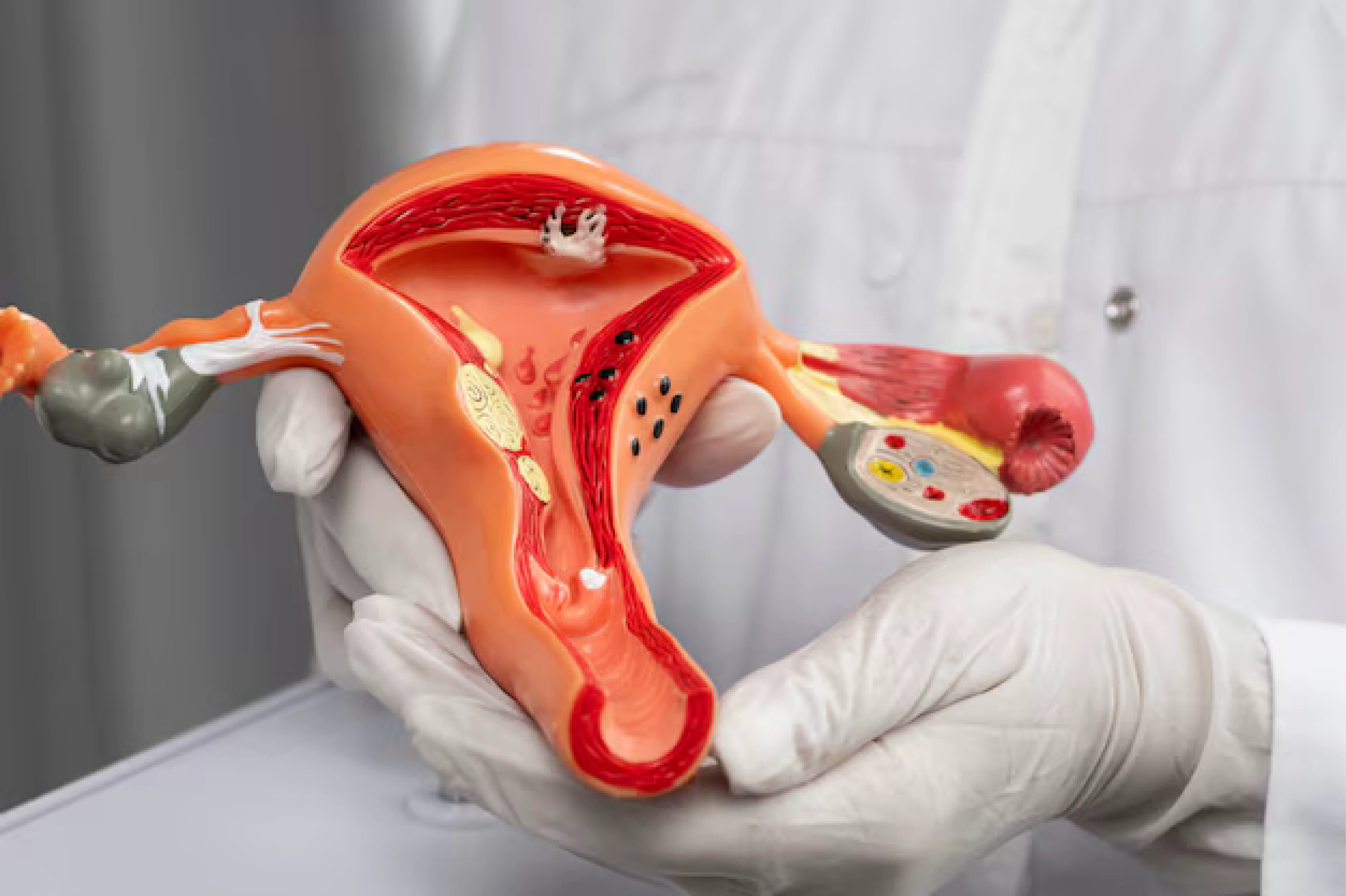 Gynecological Surgery