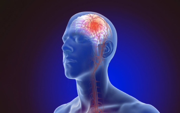 Stroke Management