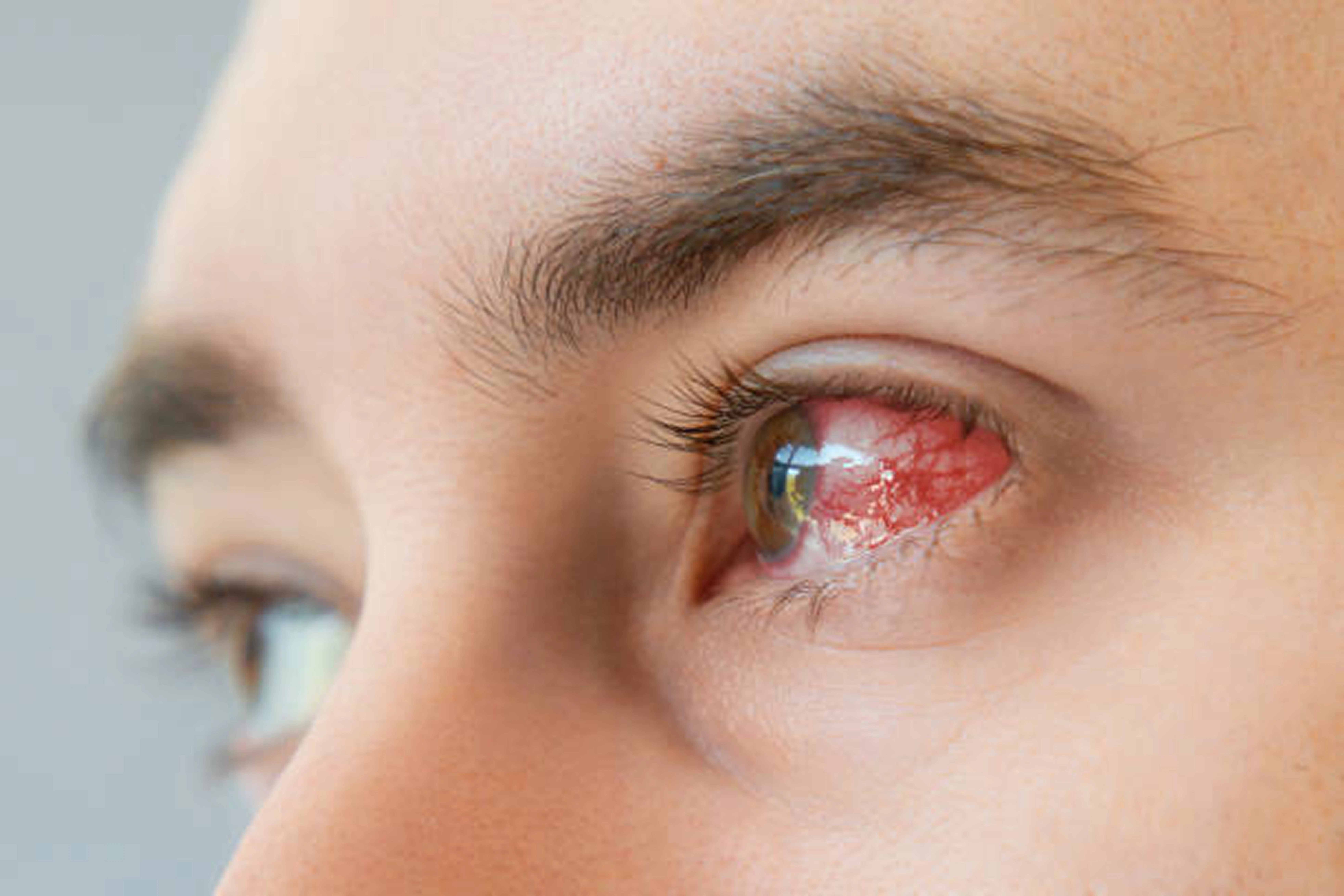 Dry Eye Treatment