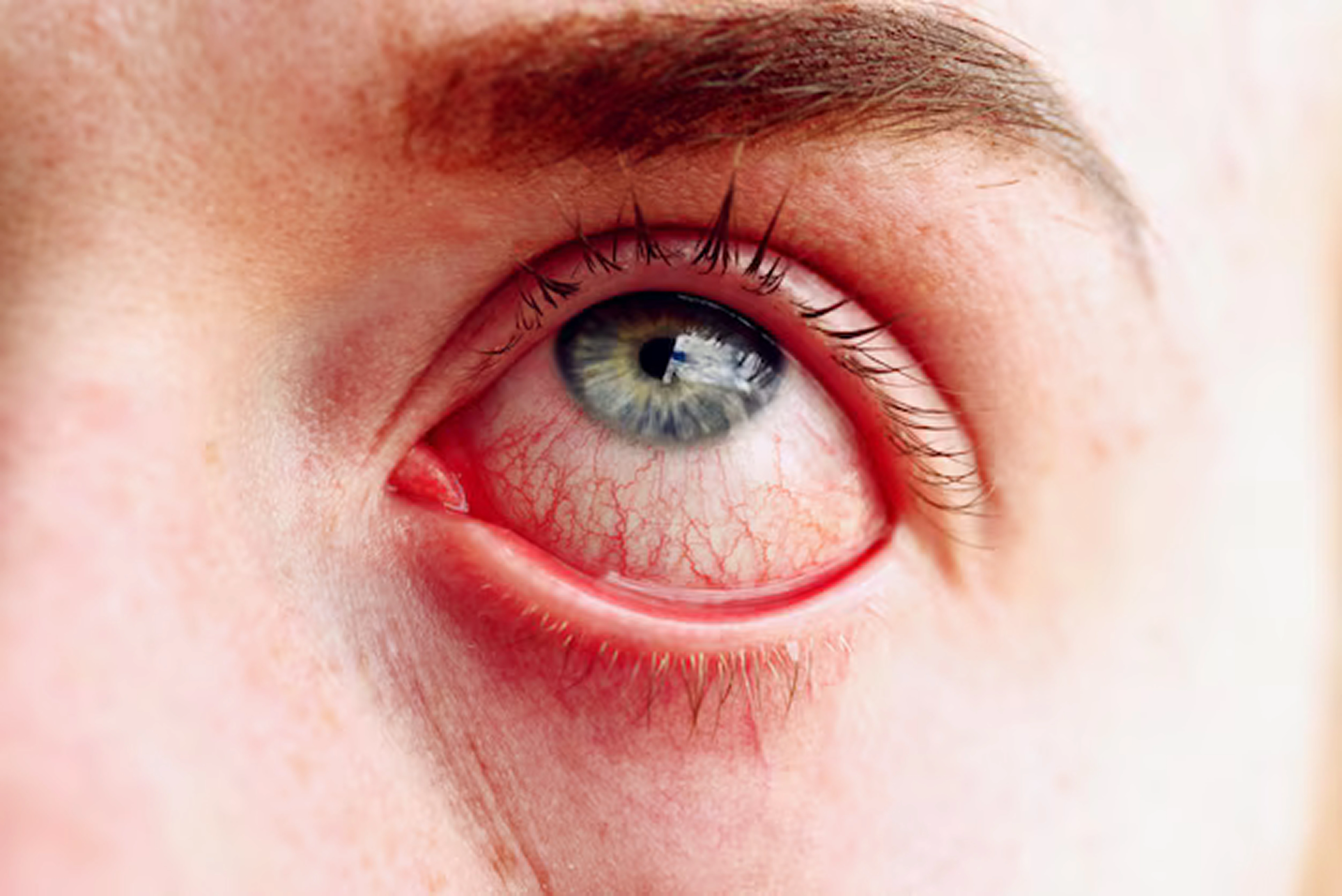 Red or Swollen Eyes