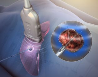 Radiofrequency Ablation (RFA)