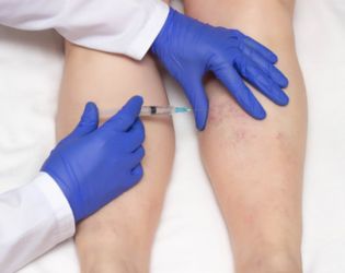 Sclerotherapy
