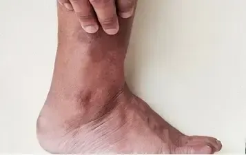 Non-Healing Wounds or Ulcers on Legs